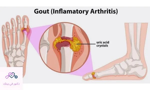 ما هي اسباب النقرس(Gout)وكيفية علاجه_دكتور في بيتك