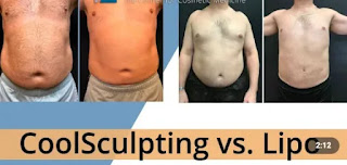 COOL SCULPTING VS. LIPOSUCTION: WHICH IS THE BEST FOR YOUR BULGE?_Ichhori.com