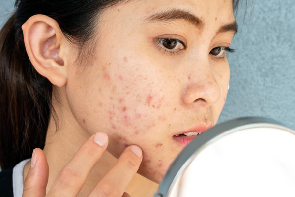 Cheapest Home Remedies To Cure Acne!