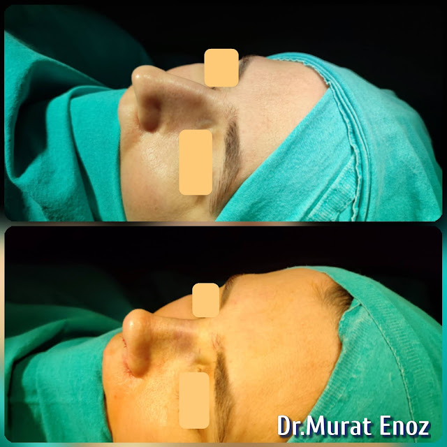 nose job,Natural rhinoplasty in Istanbul,Natural looking nasal aesthetic surgery,nose reshaping,