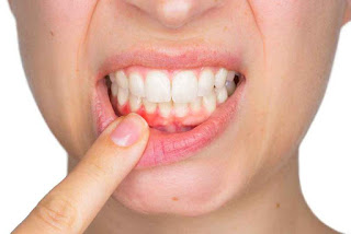 Cách chữa tụt lợi chân răng hiện đại tại nha khoa-3