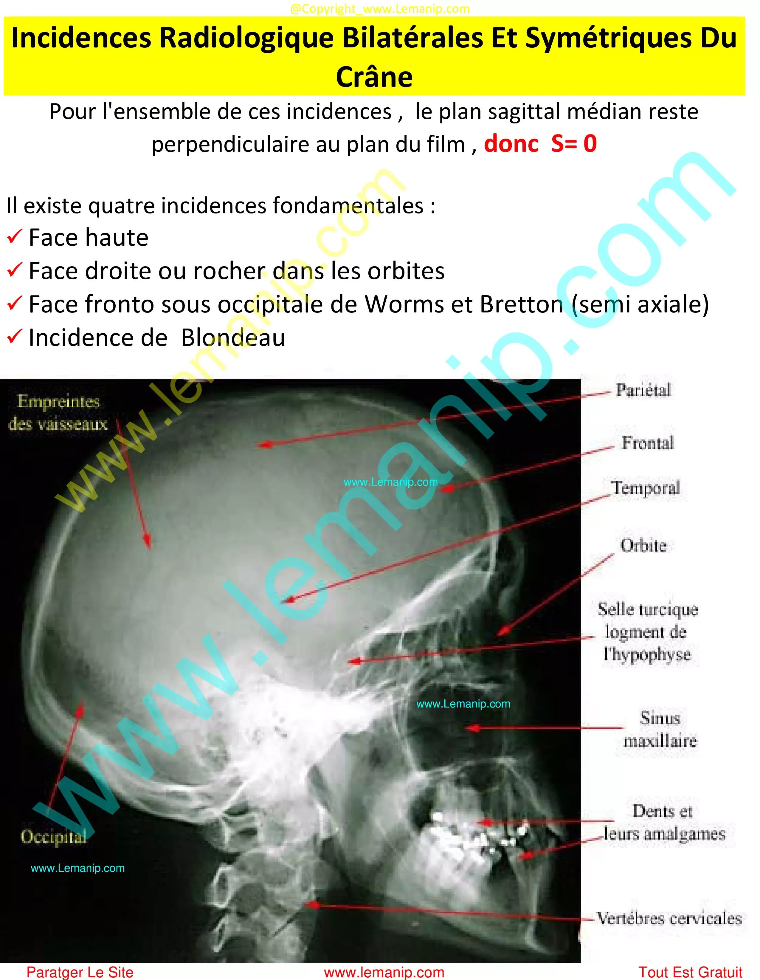 la crane,la crâne,human skull,multiple myeloma skull xray,skull osteoma radiology,skull learning anatomy,exploded skull model,skull anatomy poster,giraffe skull,baboon skull