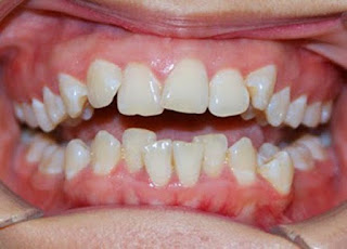 Quy trình niềng răng lệch lạc-2
