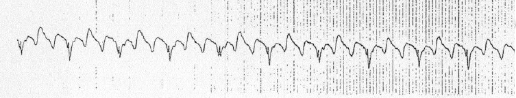 atriyal-flutter-ritim-ekg2