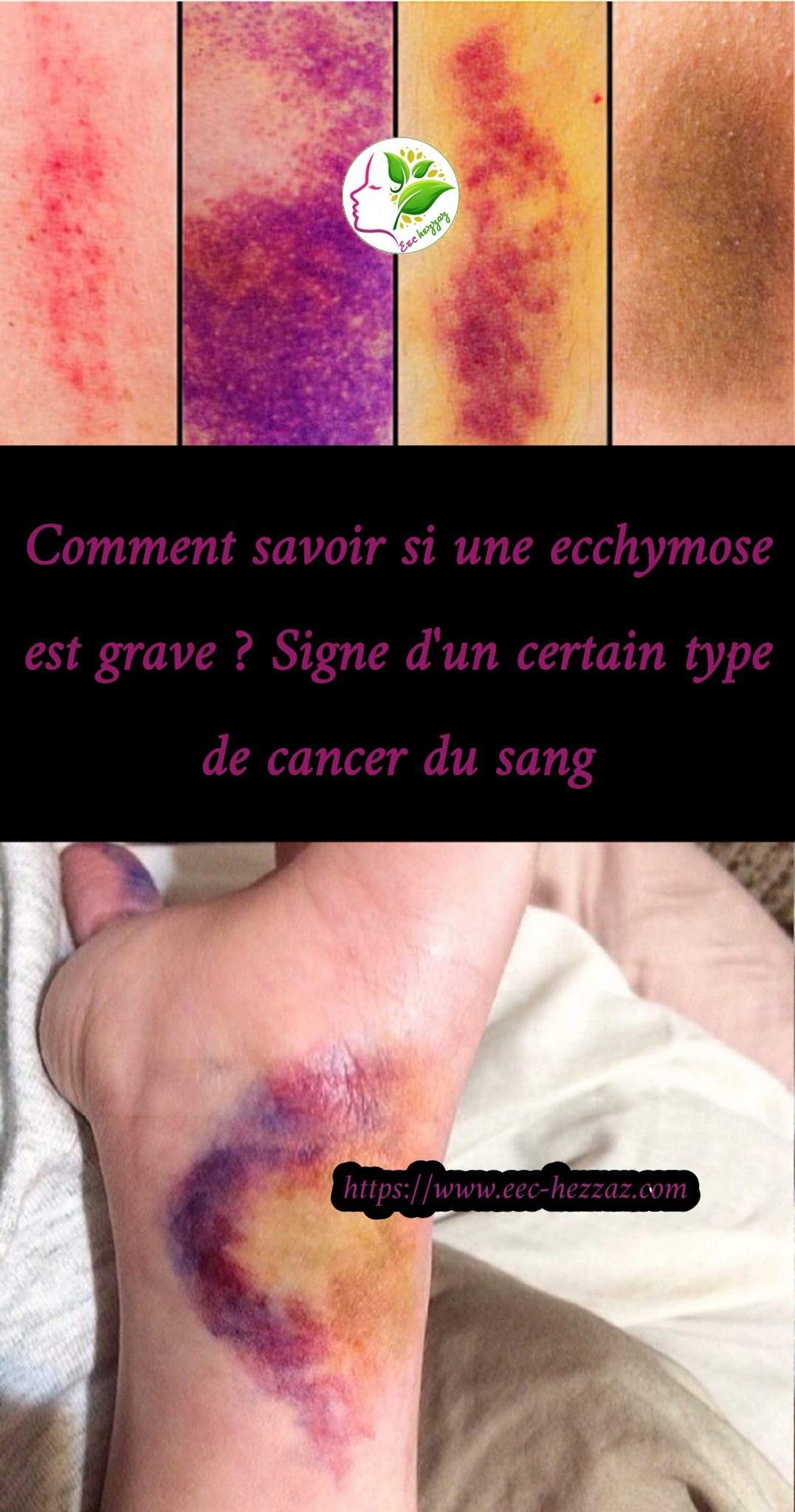 Comment savoir si une ecchymose est grave ? Signe d'un certain type de cancer du sang