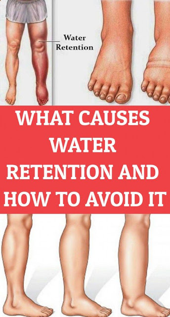 What Causes Water Retention And How To Avoid It