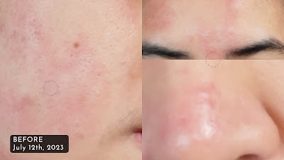 before-after-review-skintific-msh-niacinamide-moisture-gel-bintangmahayana-com