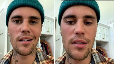 Justin announced on Instagram that he has Ramsay Hunt syndrome, is caused by the varicella-zoster virus. after chickenpox
