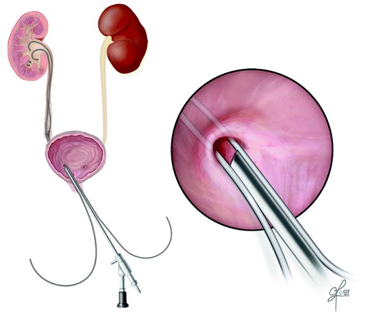 Flexible and Semi-rigid Ureteroscopy Market Global Manufacturers, Top Key Leaders and Forecast to 2027