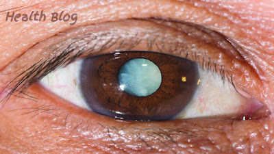 Home Remedies for Cataracts