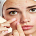 Top 10 Herbal Ways to Cure Acne and Rash