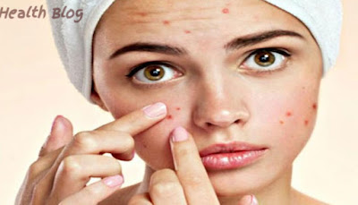 Top 10 Herbal Ways to Cure Acne and Rash