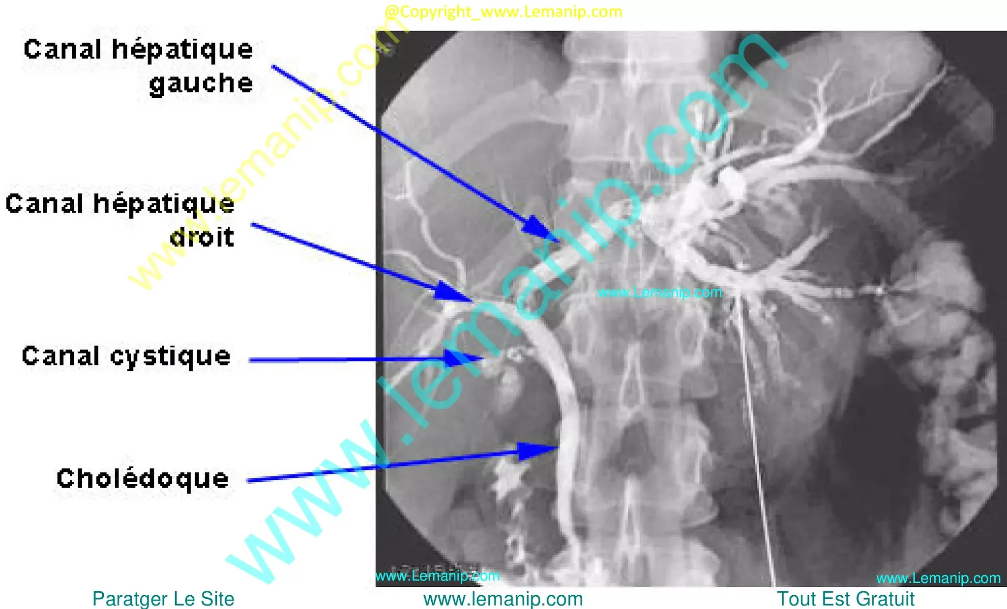 percutaneous transhepatic cholangiography,transhepatic cholangiography,bile duct cancer hands,hilar bile duct cancer,imfinzi biliary tract cancer,biliary tract cancer,biliary tree cancer,stage 2 bile duct cancer,biliary cancer,extrahepatic bile duct cancer