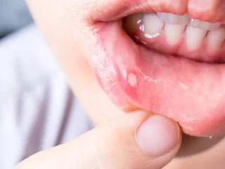 Mouth Ulcers