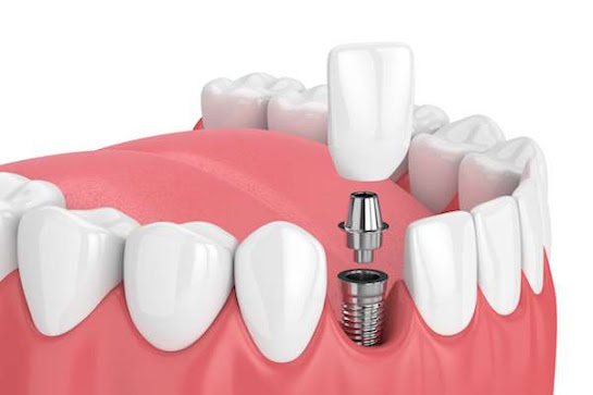 What Are the Benefits of Dental Implants?