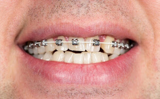 Quy trình niềng răng mắc cài kim loại-1