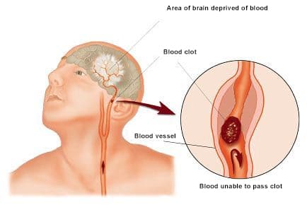 Dynapharm supplements for stroke cause by blood clots