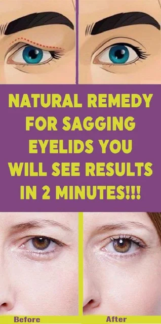 Natural Remedy for Sagging Eyelids – You Will See Results in 2 Minutes!