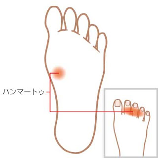 足裏のタコの場所とハンマートゥの関係を表したイラスト。詳細は下記にて説明。