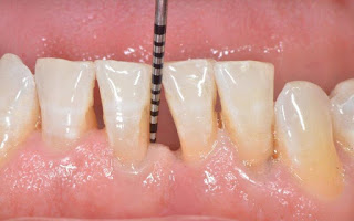 Cách chữa tụt lợi chân răng hiện đại tại nha khoa-4