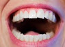Desgastes dentales causados por bruxismo, ácidos