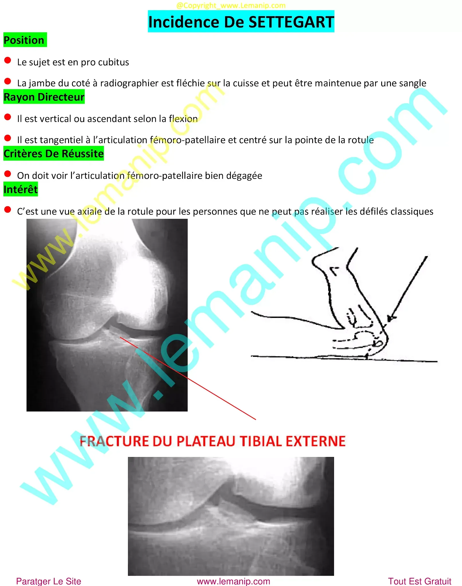 knee doctor,ball joint centre,short femur in fetus,lower ball joint replacement near me,intramedullary femur,femur pain after hip replacement,broken femur during hip replacement,medial patellofemoral ligament,mid thigh pain after hip replacement,knee dr