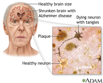 Alzheimer's-disease-a-zheimer's-disease-brain