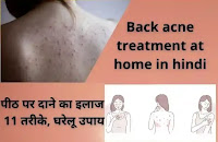 Back Acne Treatment At Home in Hindi। पीठ पर दाने का इलाज 13 घरेलू उपाय