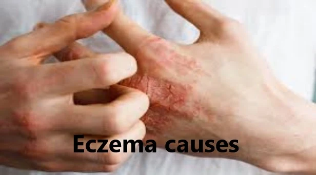 Treatment of eczema in adults