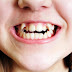 Răng khểnh có đẹp không? Có nên thực hiện chỉnh sửa?