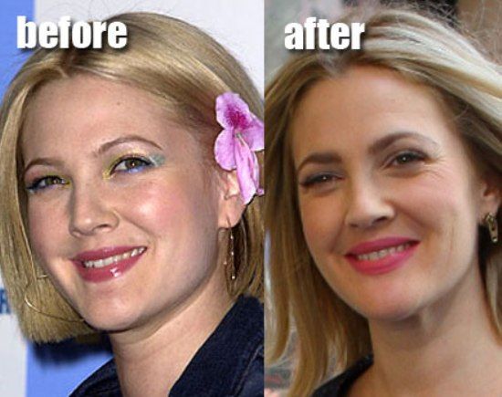 Drew-Barrymore-Plastic-Surgery