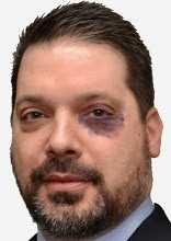 Martin's #5 Defeated Dolt "attorney" Armando Brigandi w/ Self-Inflicted Black Eye