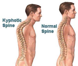 Kyphosis : Physiotherapy Treatment and exercise