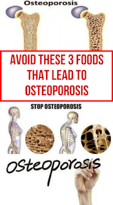 Avoid These 3 Foods That Lead To Osteoporosis