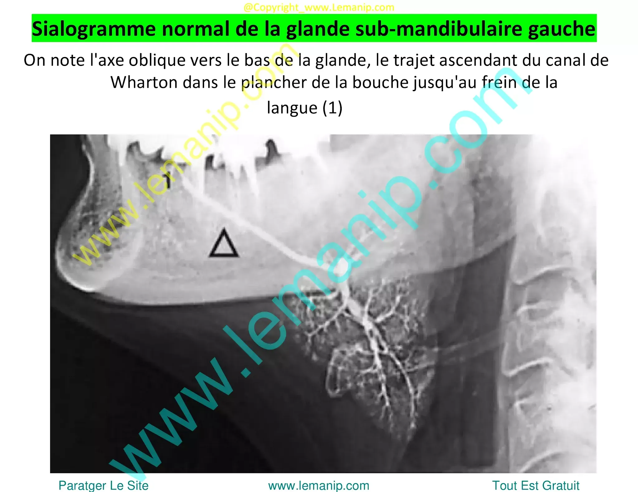 removing salivary gland,sjogren's swollen glands,left parotid,parotid duct,stensen's duct,parotid gland duct,swollen parotid glands both sides,swollen parotid gland on both sides,superficial parotid,inflamed salivary gland