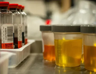 What does color of the urine means: Causes, what it means, and types of urine colors for women? ichhori.com