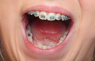 Quy trình niềng răng mắc cài cài kim loại-1