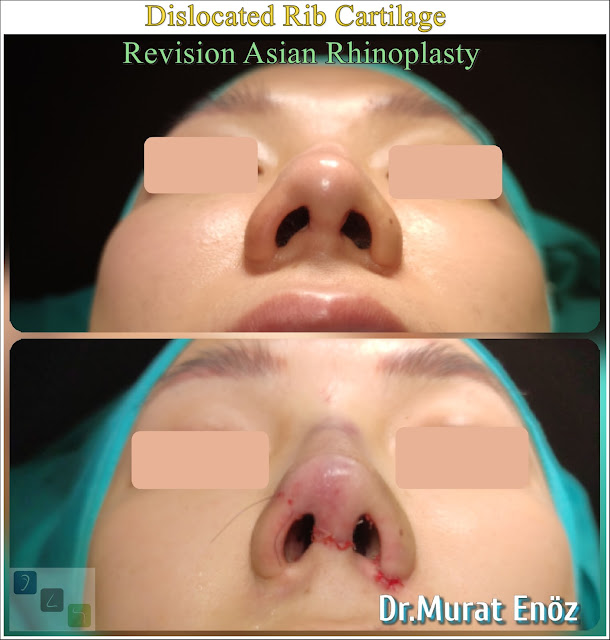 nose job, revision asian nose aesthetic in istanbul, asian secondary revision rhinoplasty,  asian thick skinned revision rhinoplasty in Turkey