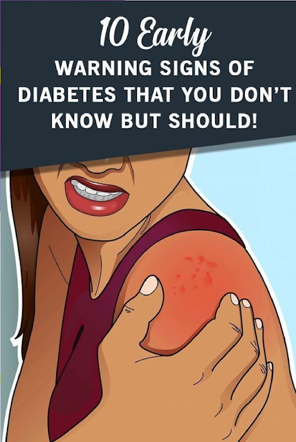 10 Early Warning Signs Of Diabetes Everyone Should Know!