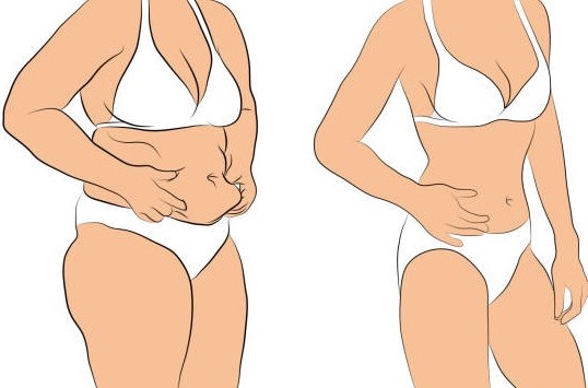 복부 뱃살 지방흡입