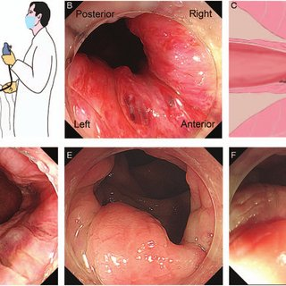 WHAT IS PILES / HEMORRHOIDS? MAIN CAUSES, REASONS, DIAGNOSIS, AND HOMOEOPATHY TREATMENT