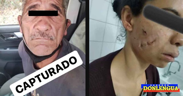 Capturado un depravado en Los Teques por desfigurar la cara de su pareja