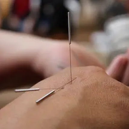 Acupuncture  for pain relief : treatment  for many forms