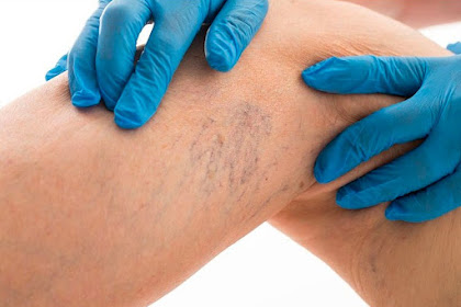 What Causes Spider Veins?