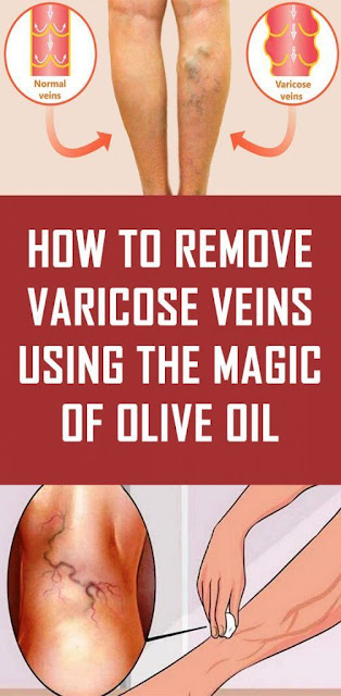 By using olive oil you can get rid of varicose veins