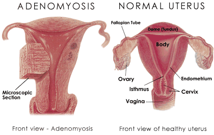 WHAT IS HYPOPLASTIC? CAN THE UTERUS SIZE INCREASED?WHAT CAUSES FORMATION OF SMALL UTERUS? HYPOPLASTIC UTERUS SYMPTOMS,HYPOPLASTIC UTERUS DIAGNOSIS,HYP-LASTIC UTERUS TREATMENT