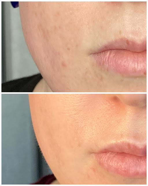 SkinPen before and after