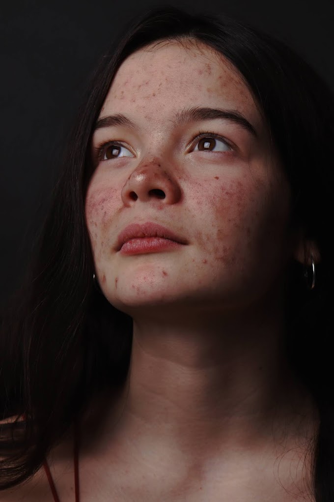 The Powerful Home Remedies for Acne. How to Get Rid of Acne