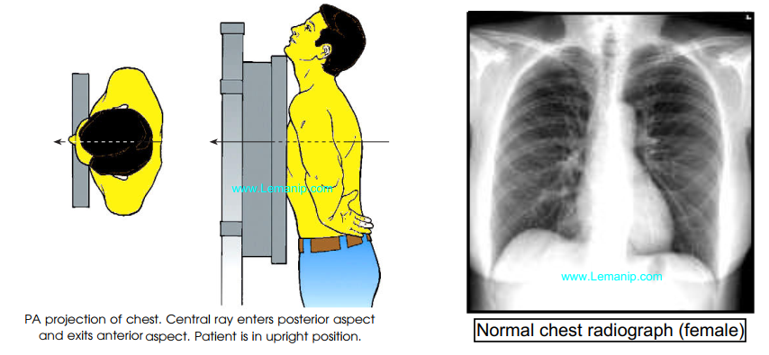 mesothelioma chest x ray,asthma chest x ray,asthma lungs x ray,mesothelioma x ray,cdh xray,asbestosis chest x ray,asbestos lung x ray,asbestosis x ray,hmi xray,asthma x ray