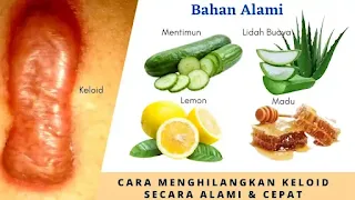 Cara Menghilangkan Keloid Secara Alami